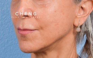 Hidden Patients Before & After Gallery - Patient 372181 - Image 3
