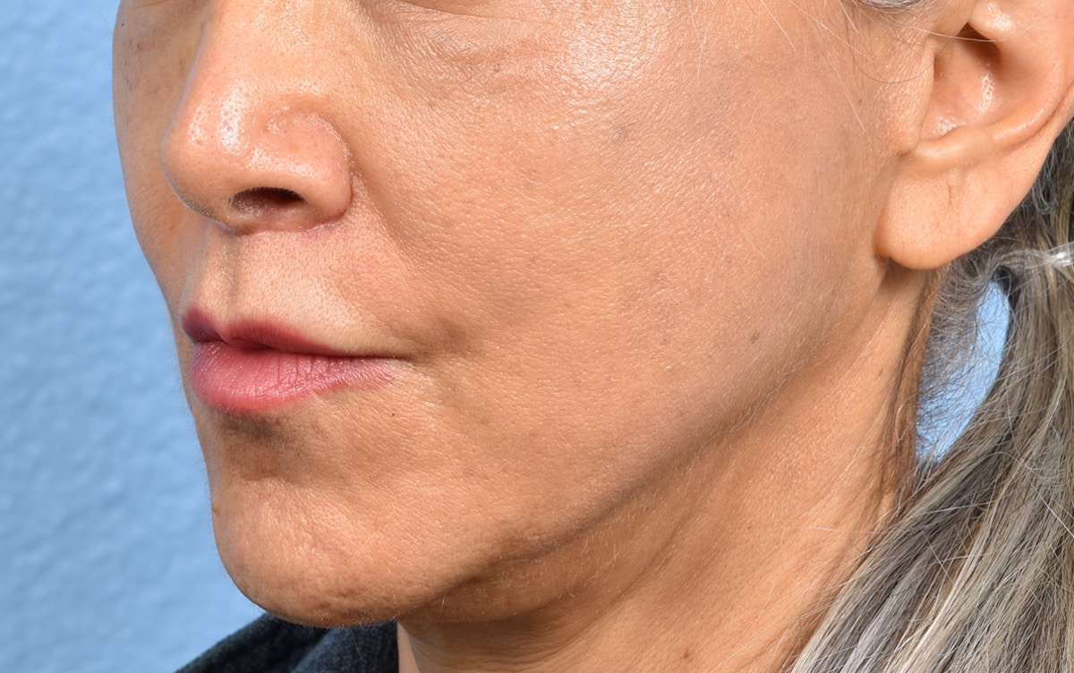 Lip Lift Before & After Gallery - Patient 376152 - Image 4