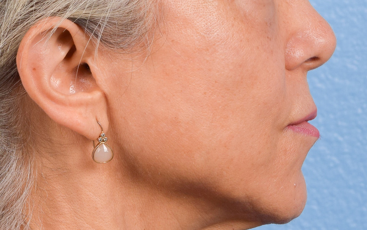 Lip Lift Before & After Gallery - Patient 376152 - Image 5