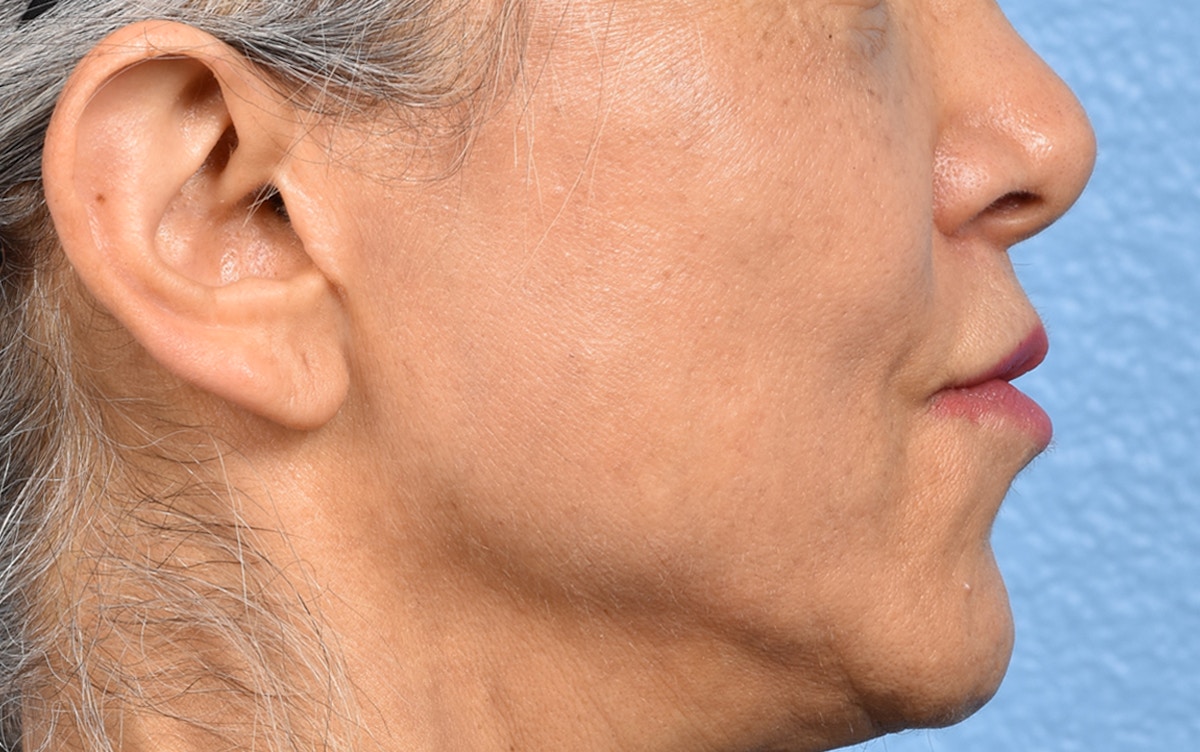 Lip Lift Before & After Gallery - Patient 376152 - Image 6