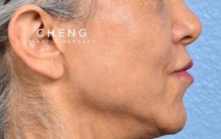 Hidden Patients Before & After Gallery - Patient 372181 - Image 6