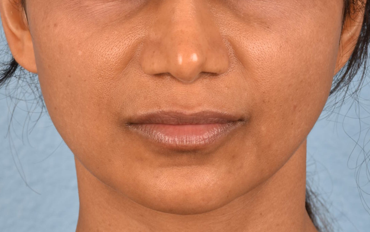Lip Lift Before & After Gallery - Patient 369454 - Image 1
