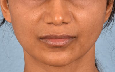 Lip Lift Before & After Gallery - Patient 369454 - Image 1