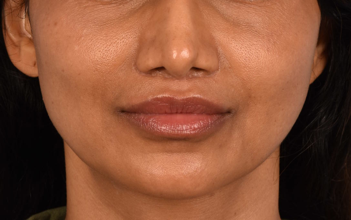 Lip Lift Before & After Gallery - Patient 369454 - Image 2