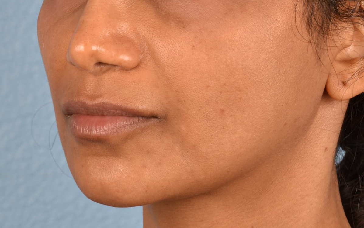 Lip Lift Before & After Gallery - Patient 369454 - Image 3