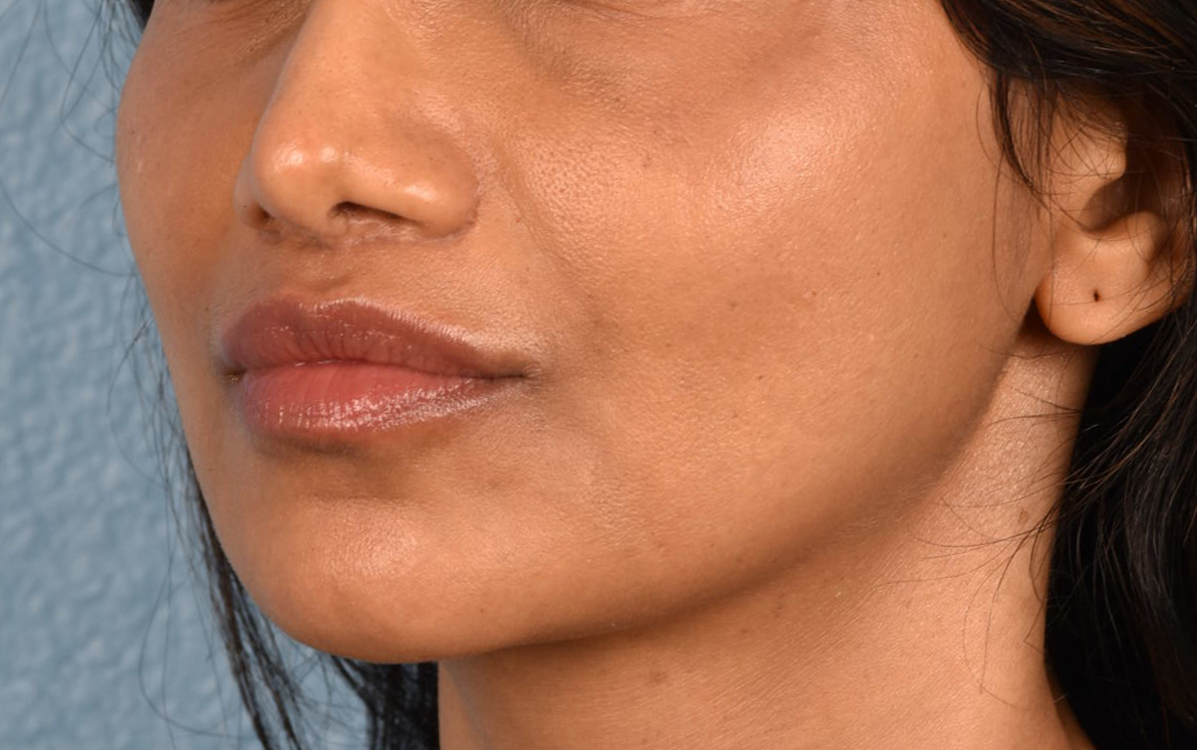 Lip Lift Before & After Gallery - Patient 369454 - Image 4