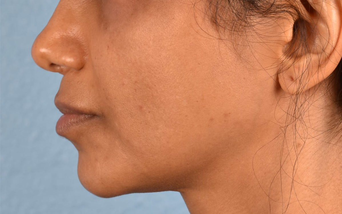 Lip Lift Before & After Gallery - Patient 369454 - Image 5