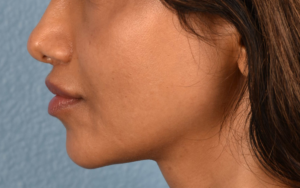 Lip Lift Before & After Gallery - Patient 369454 - Image 6