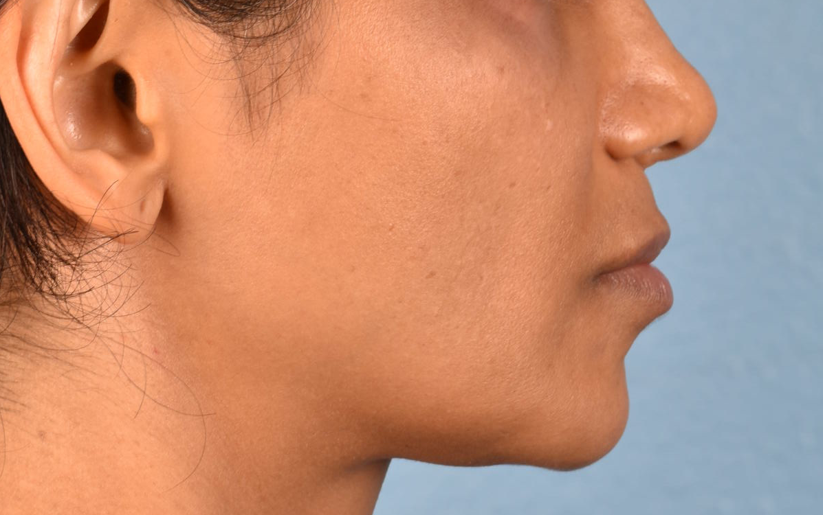 Lip Lift Before & After Gallery - Patient 369454 - Image 7