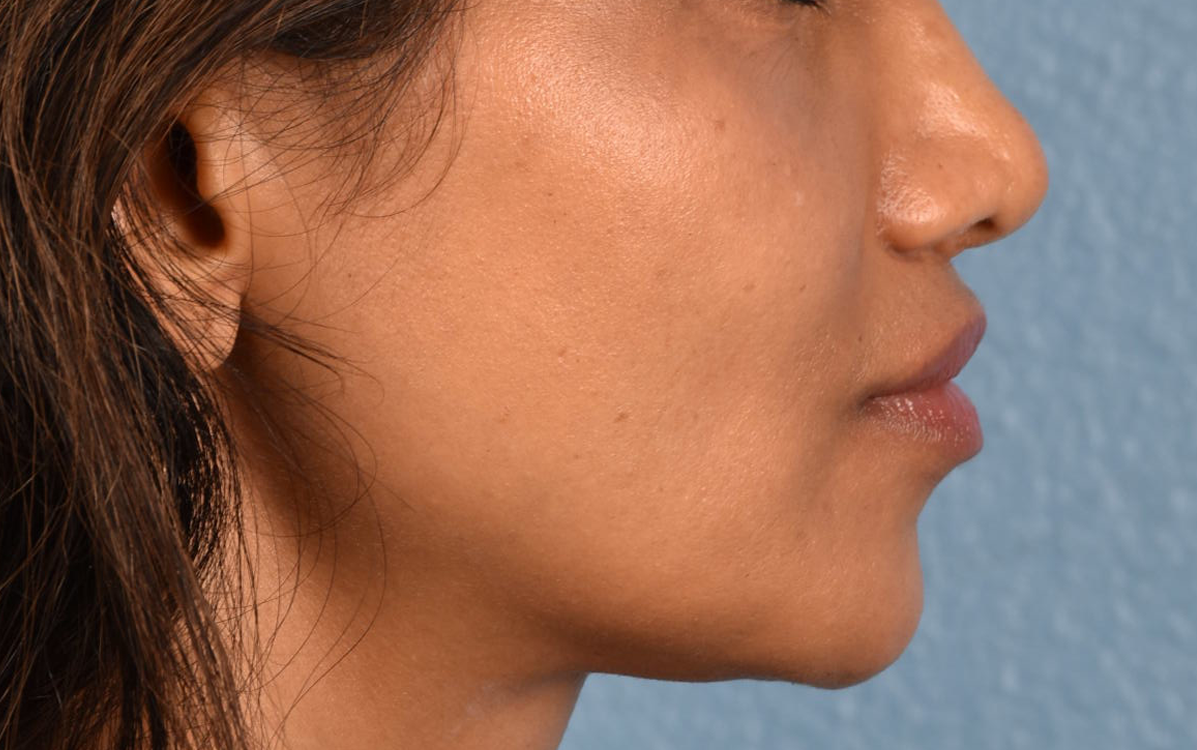 Lip Lift Before & After Gallery - Patient 369454 - Image 8