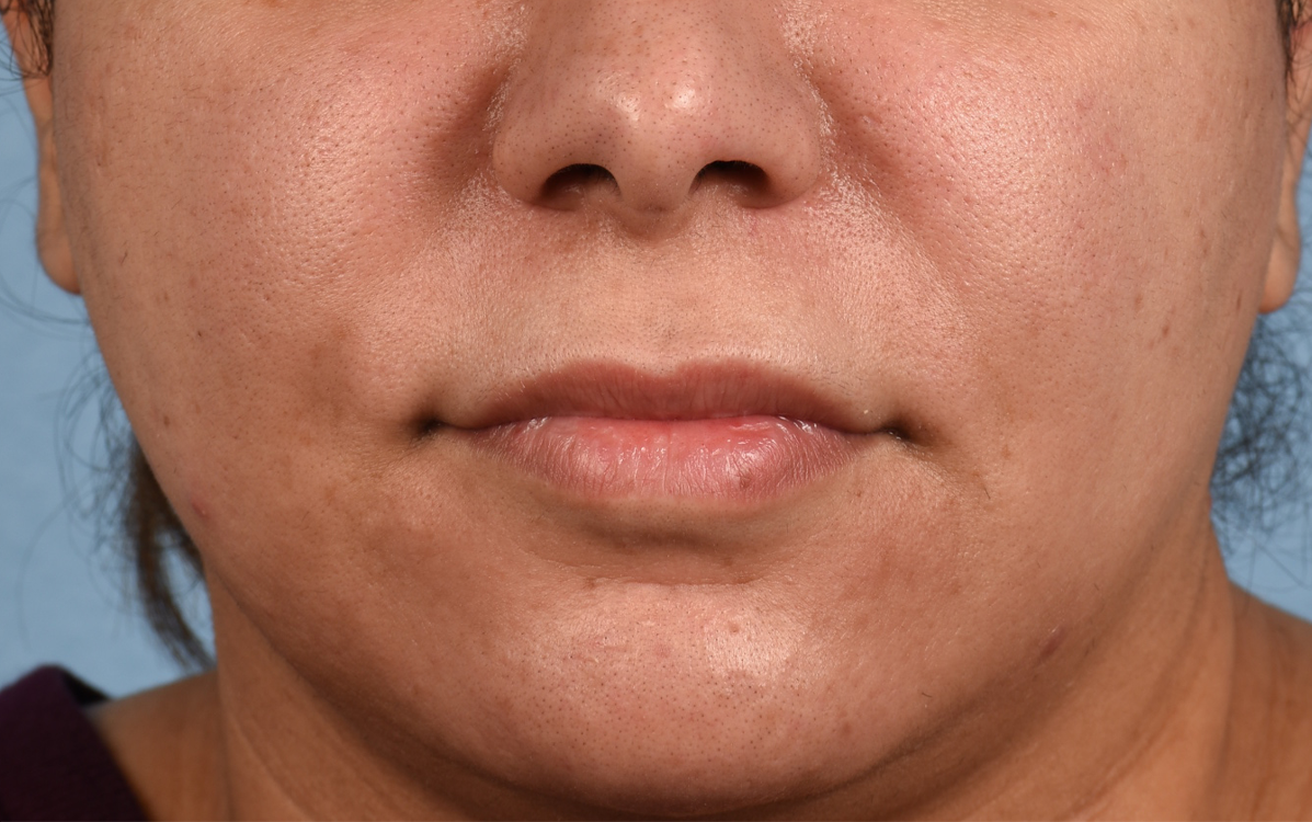 Hidden Patients Before & After Gallery - Patient 279952 - Image 1