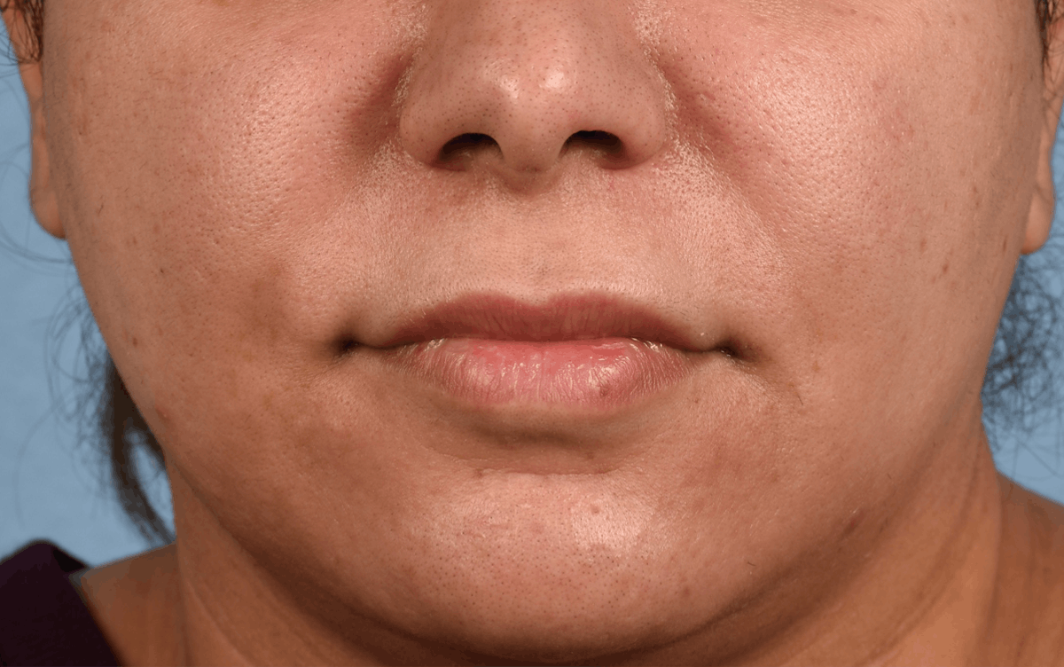 Lip Lift Before & After Gallery - Patient 155977 - Image 1