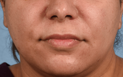 Lip Lift Before & After Gallery - Patient 155977 - Image 1