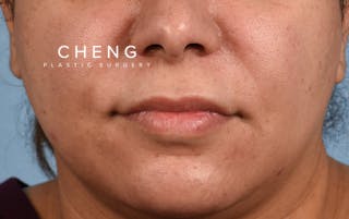 Hidden Patients Before & After Gallery - Patient 279952 - Image 1