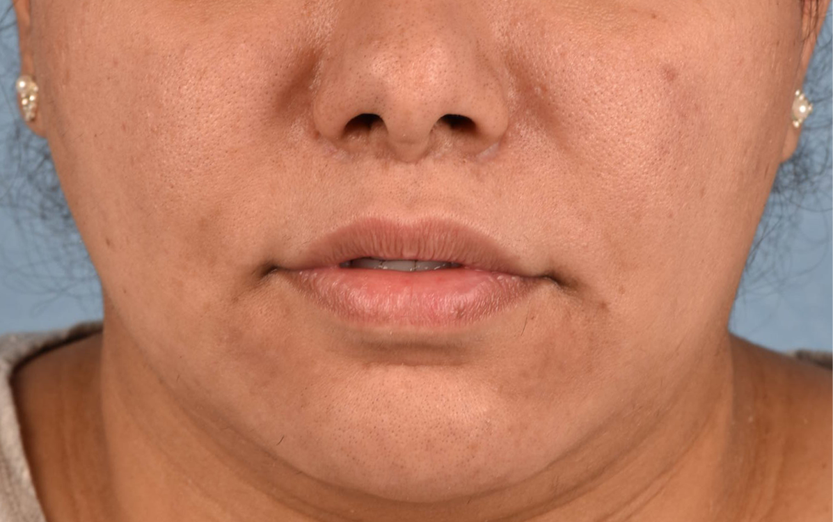 Hidden Patients Before & After Gallery - Patient 279952 - Image 2