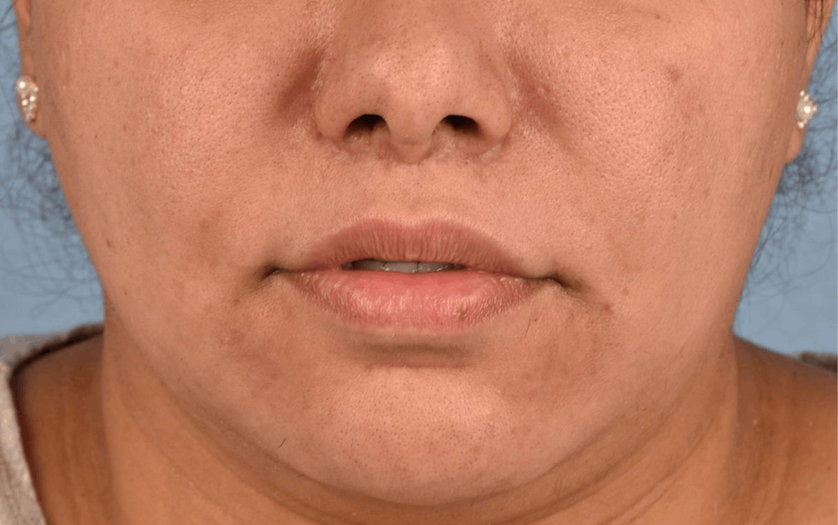 Lip Lift Before & After Gallery - Patient 155977 - Image 2