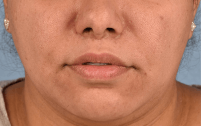 Lip Lift Before & After Gallery - Patient 155977 - Image 2