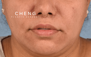 Hidden Patients Before & After Gallery - Patient 279952 - Image 2
