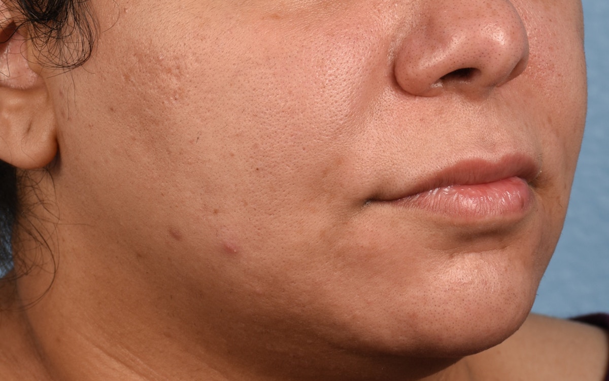 Lip Lift Before & After Gallery - Patient 155977 - Image 3
