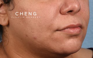Hidden Patients Before & After Gallery - Patient 279952 - Image 3