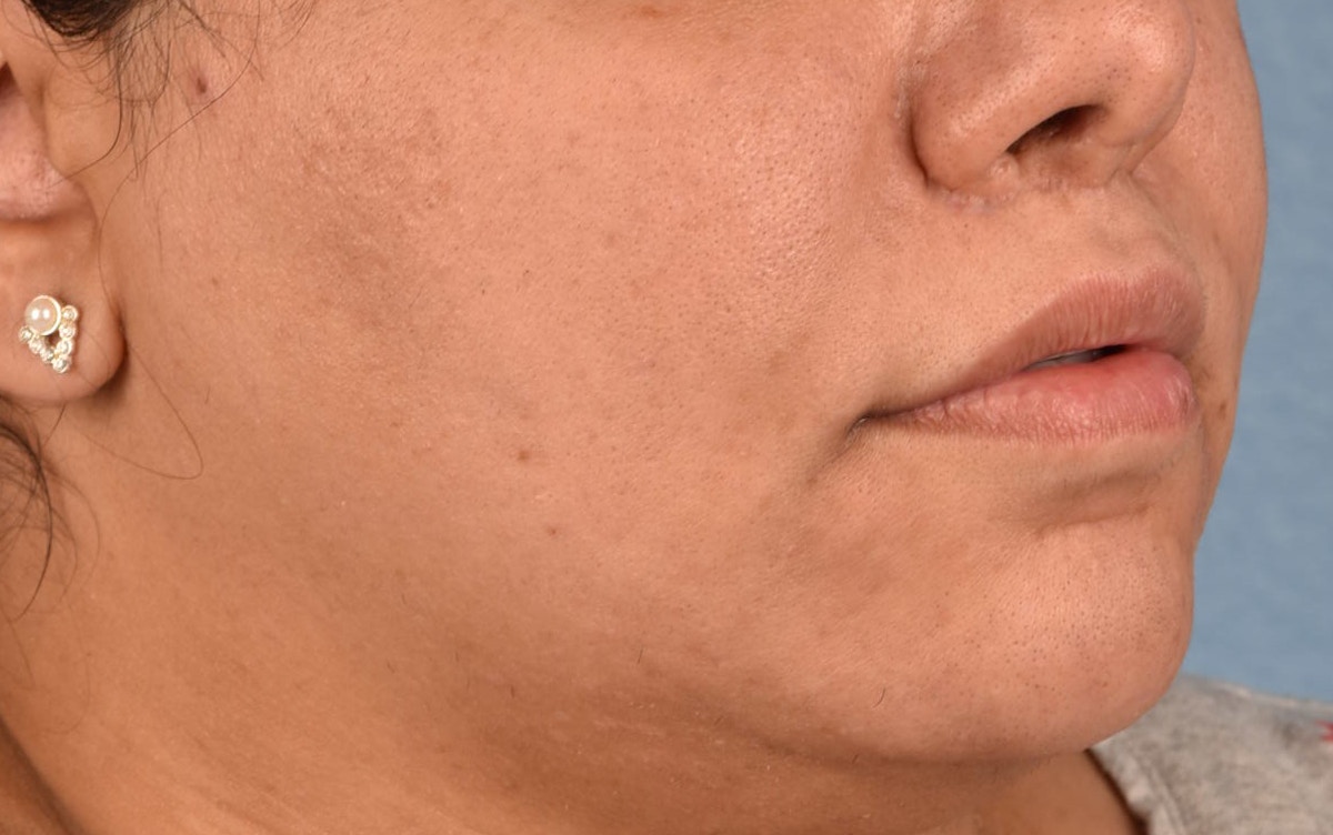 Lip Lift Before & After Gallery - Patient 155977 - Image 4