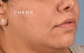 Hidden Patients Before & After Gallery - Patient 279952 - Image 4