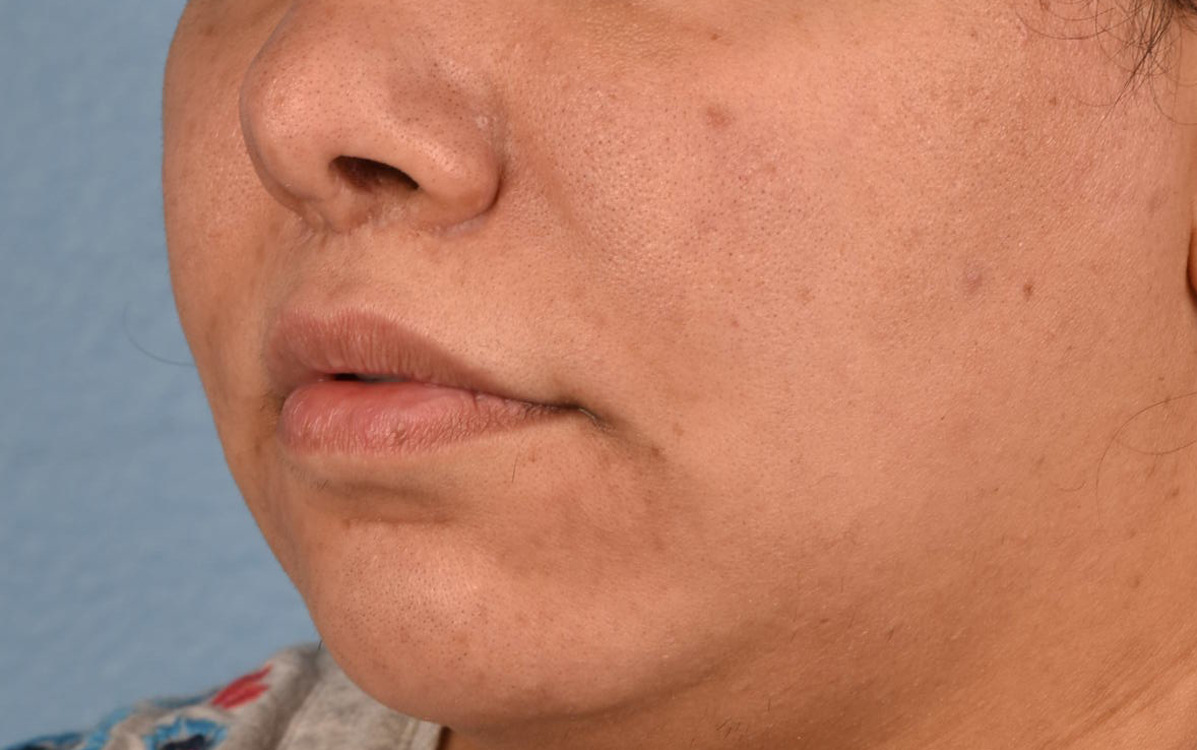 Hidden Patients Before & After Gallery - Patient 279952 - Image 6