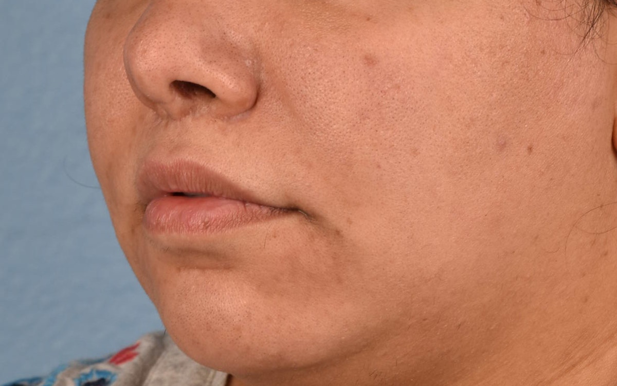 Lip Lift Before & After Gallery - Patient 155977 - Image 6