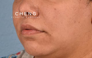 Hidden Patients Before & After Gallery - Patient 279952 - Image 6