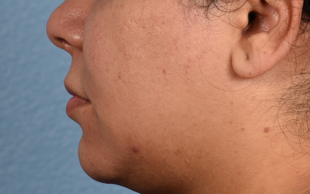 Lip Lift Before & After Gallery - Patient 155977 - Image 7