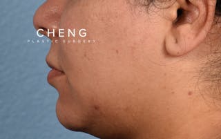 Hidden Patients Before & After Gallery - Patient 279952 - Image 7