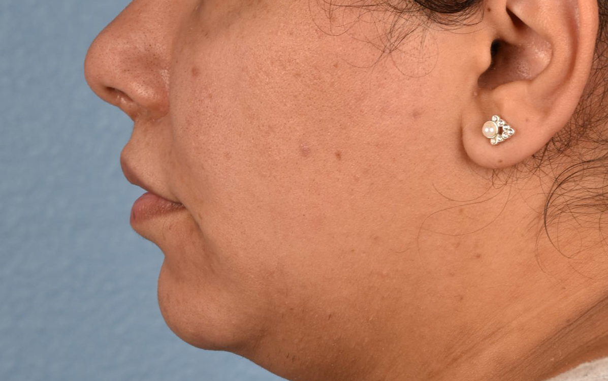 Hidden Patients Before & After Gallery - Patient 279952 - Image 8