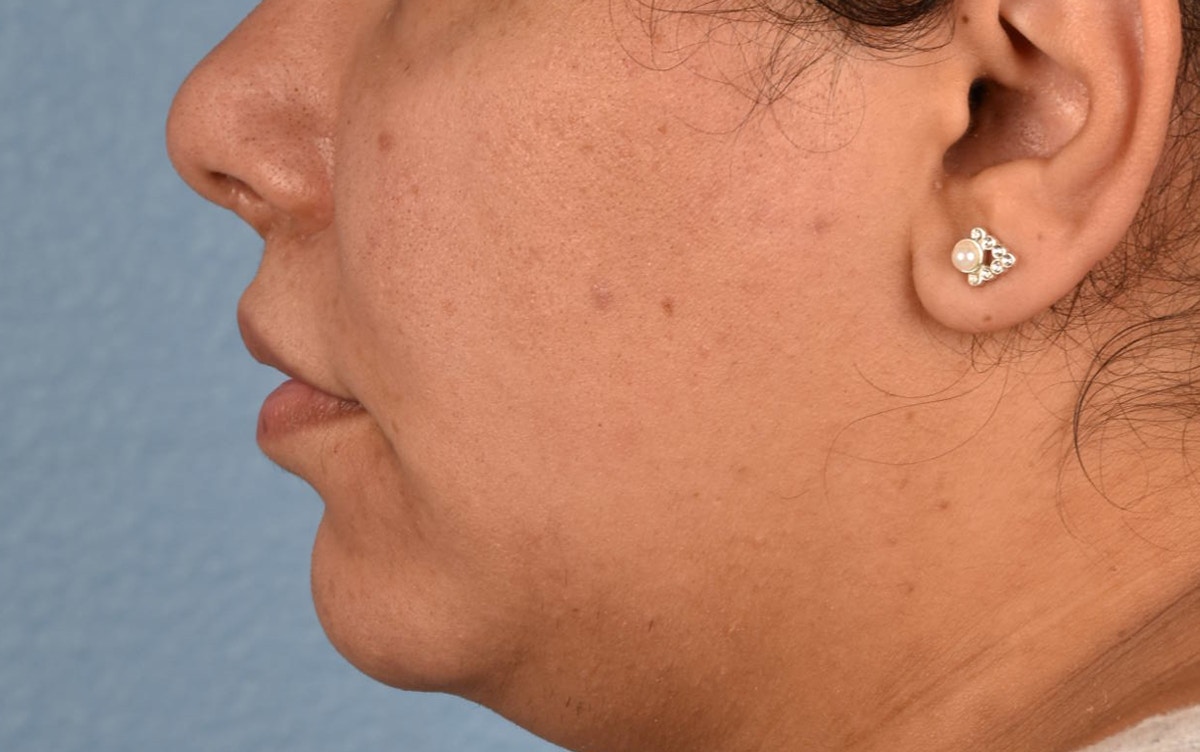Lip Lift Before & After Gallery - Patient 155977 - Image 8