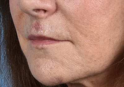 Lip Lift Before & After Gallery - Patient 277736 - Image 1