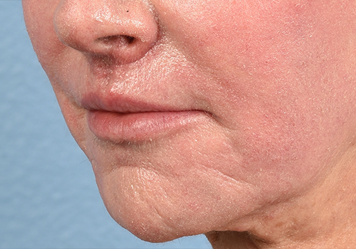 Hidden Patients Before & After Gallery - Patient 294842 - Image 2