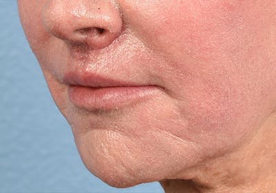 Lip Lift Before & After Gallery - Patient 277736 - Image 2