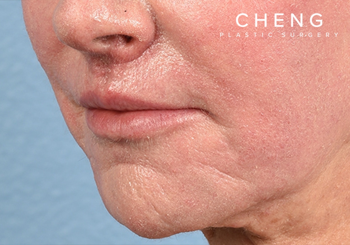 Hidden Patients Before & After Gallery - Patient 294842 - Image 2