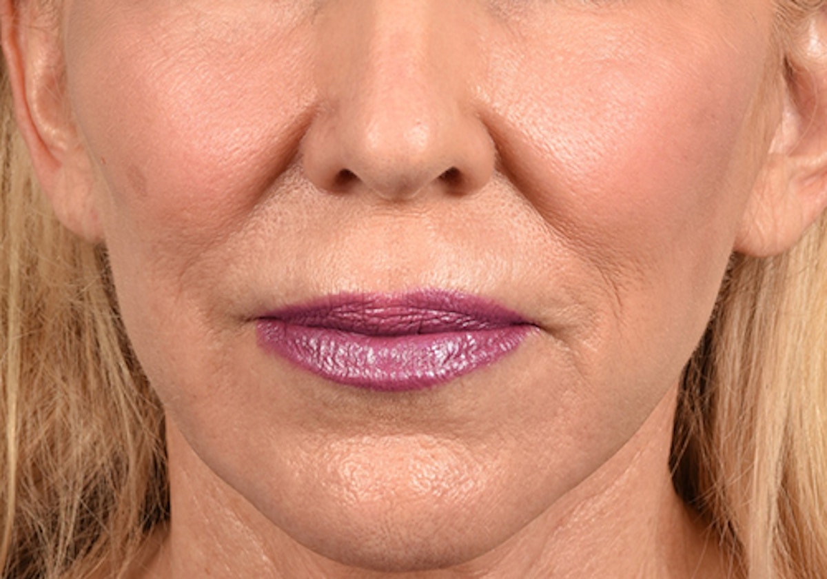 Lip Lift Before & After Gallery - Patient 698728 - Image 1