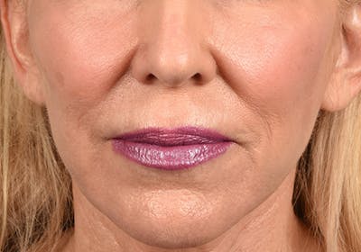 Lip Lift Before & After Gallery - Patient 698728 - Image 1