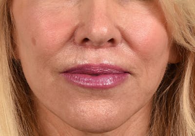 Lip Lift Before & After Gallery - Patient 698728 - Image 2