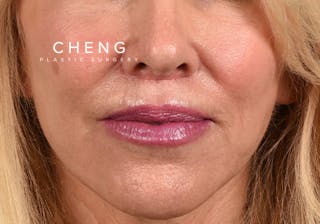 Hidden Patients Before & After Gallery - Patient 320850 - Image 2