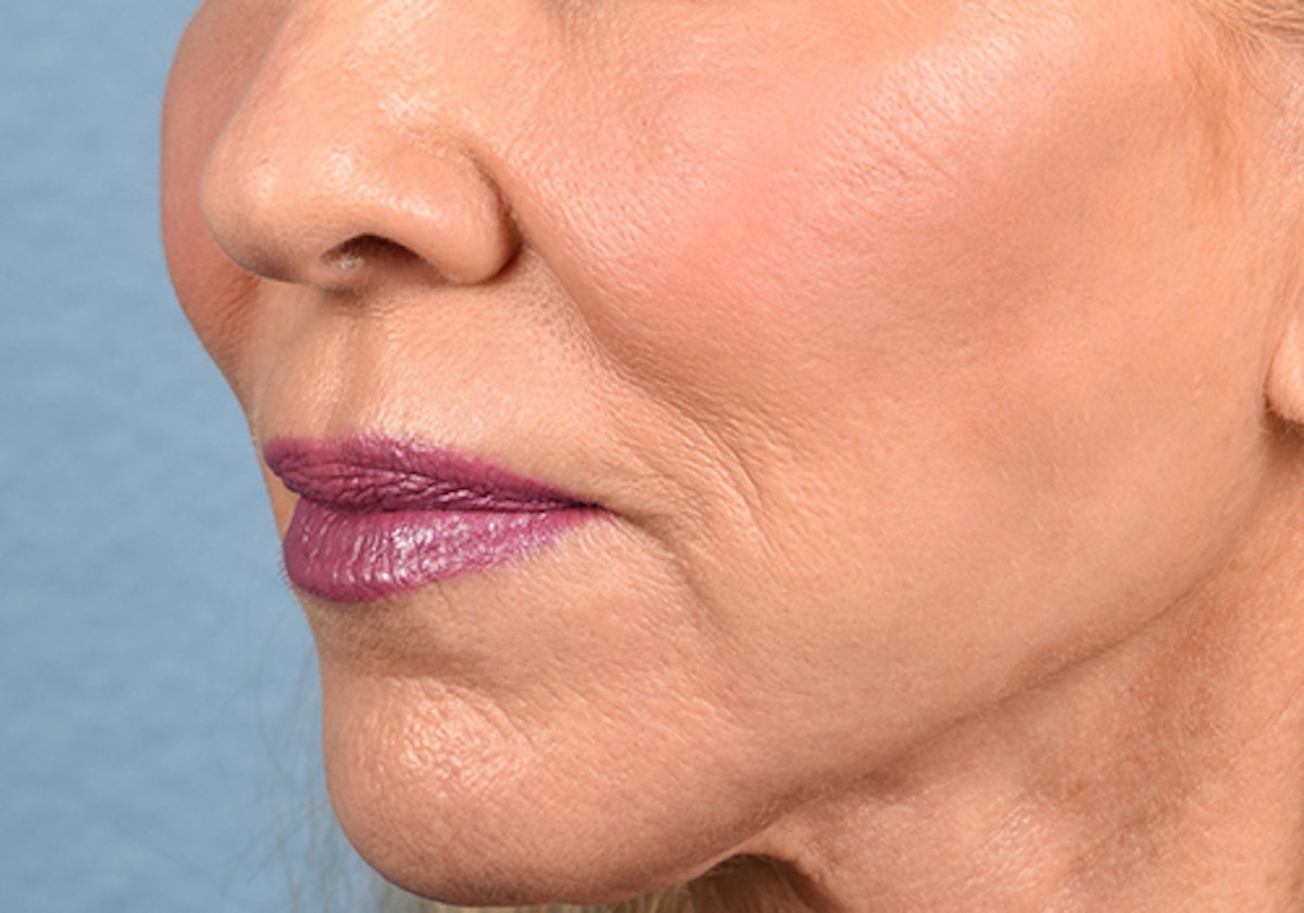 Lip Lift Before & After Gallery - Patient 698728 - Image 3