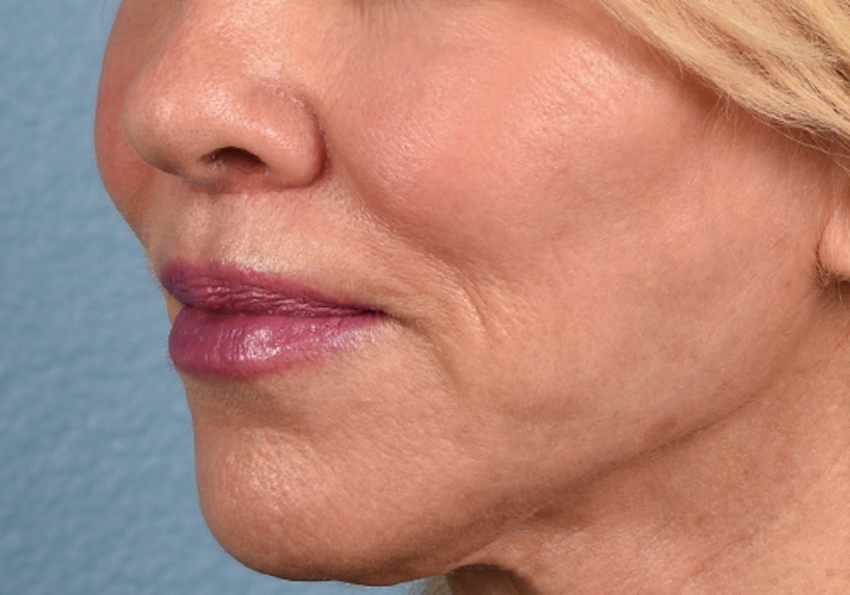 Lip Lift Before & After Gallery - Patient 698728 - Image 4
