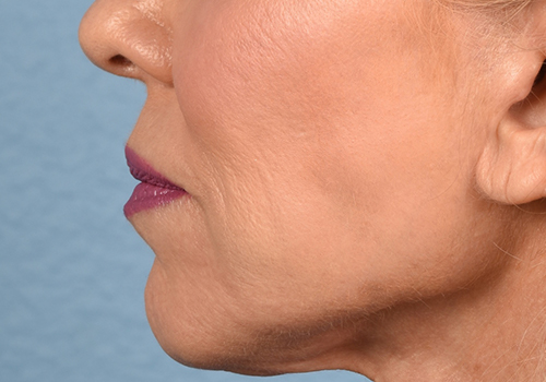 Hidden Patients Before & After Gallery - Patient 320850 - Image 5