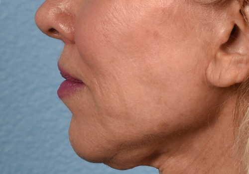 Hidden Patients Before & After Gallery - Patient 320850 - Image 6