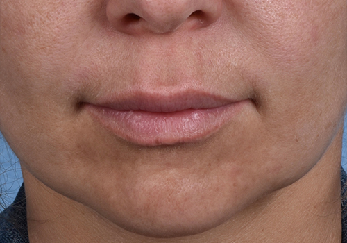 Lip Lift Before & After Gallery - Patient 797589 - Image 1