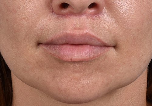 Lip Lift Before & After Gallery - Patient 797589 - Image 2