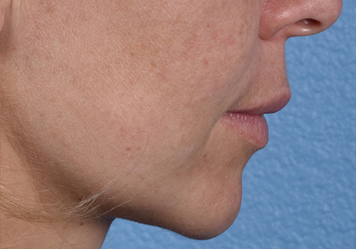 Lip Lift Before & After Gallery - Patient 797589 - Image 3