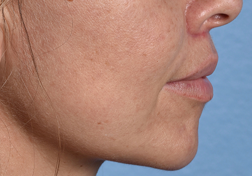 Lip Lift Before & After Gallery - Patient 797589 - Image 4