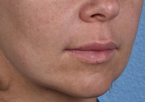 Lip Lift Before & After Gallery - Patient 797589 - Image 5